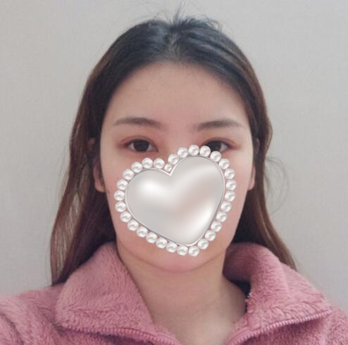 崔榮達(dá)做下頜角好嗎？案例分享