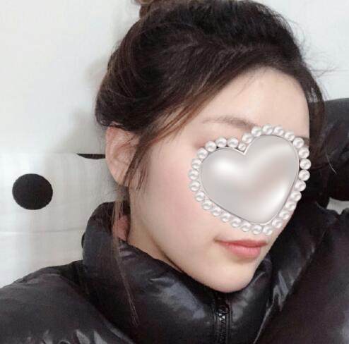 崔榮達(dá)做下頜角好嗎？案例分享