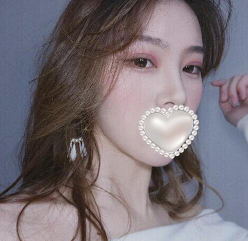 崔榮達(dá)做下頜角好嗎？案例分享