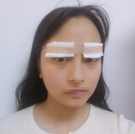 王海沐醫(yī)生雙眼皮案例分享