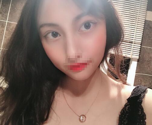 王海沐醫(yī)生雙眼皮案例分享