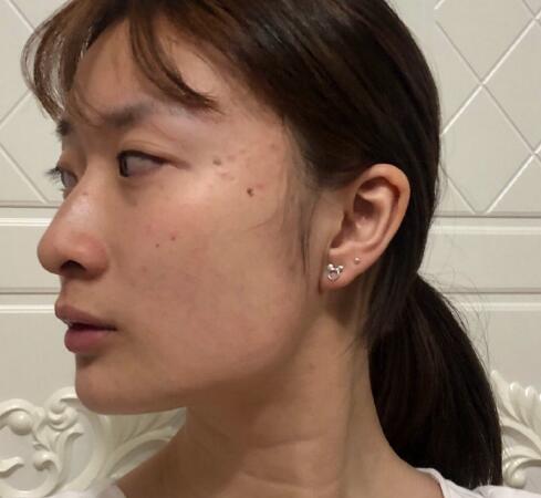 上海九院柴崗磨骨手術(shù)案例分享