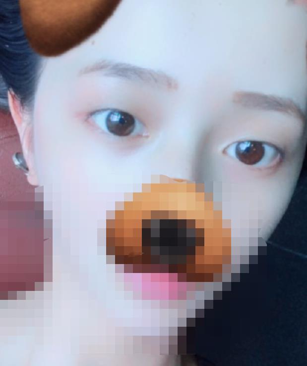 北京八大處趙延勇醫(yī)生做雙眼皮怎么樣？