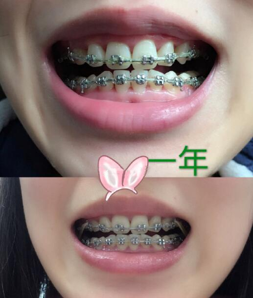 四川華西醫(yī)院口腔外科牙齒矯正案例分享