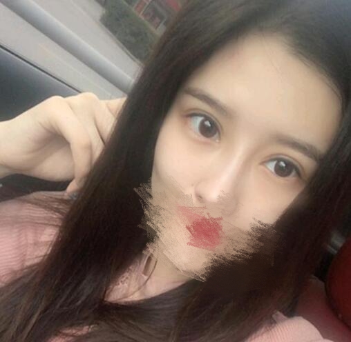 蔣小花醫(yī)生雙眼皮修復(fù)案例