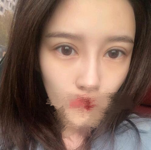 蔣小花醫(yī)生雙眼皮修復(fù)案例