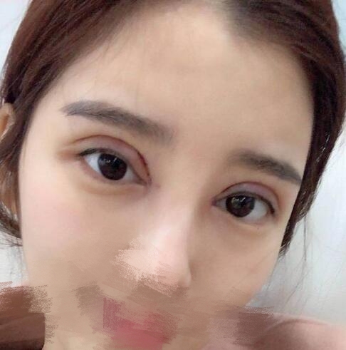 蔣小花醫(yī)生雙眼皮修復(fù)案例