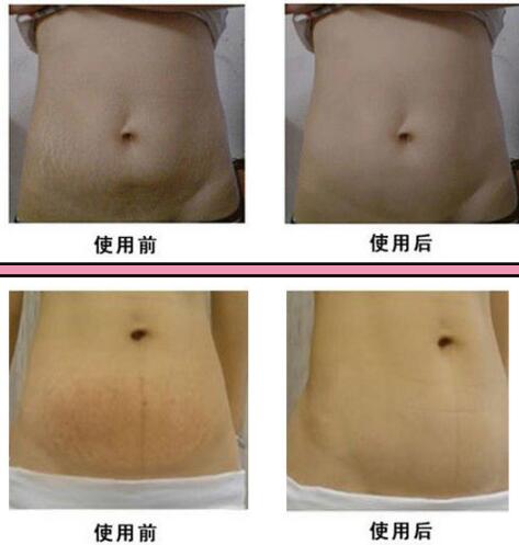 激光去妊娠紋有哪些主要優(yōu)勢