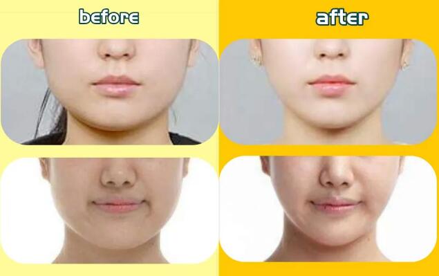 注射瘦臉打幾次能定型