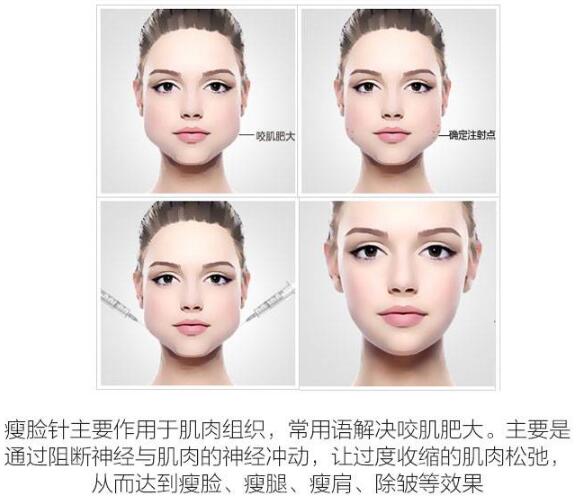 注射瘦臉打幾次能定型