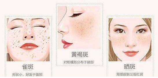 激光祛雀斑多少錢(qián)