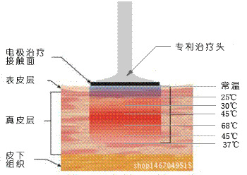 電波拉皮果怎么樣