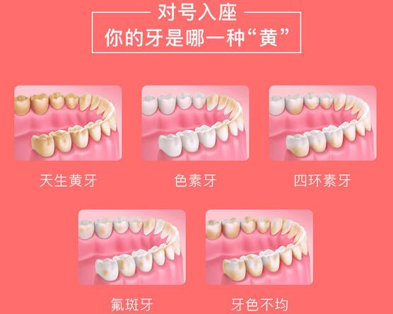 冷光美白牙齒的特點(diǎn)