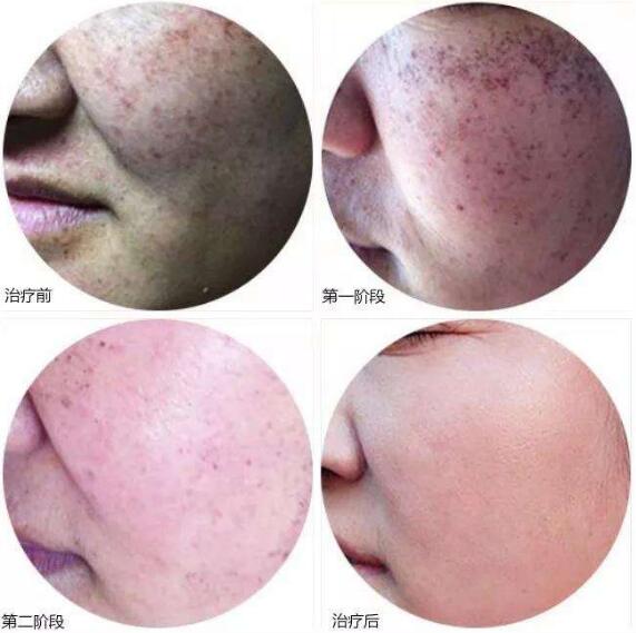 蝴蝶斑怎么治較有